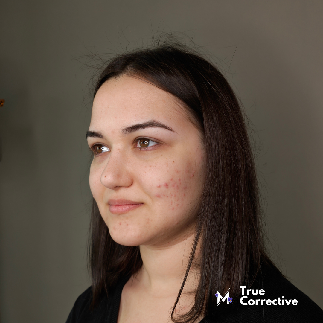 True Corrective - Corso Make Up Online copertura Acne e Imperfezioni in Cream e Gel Technique